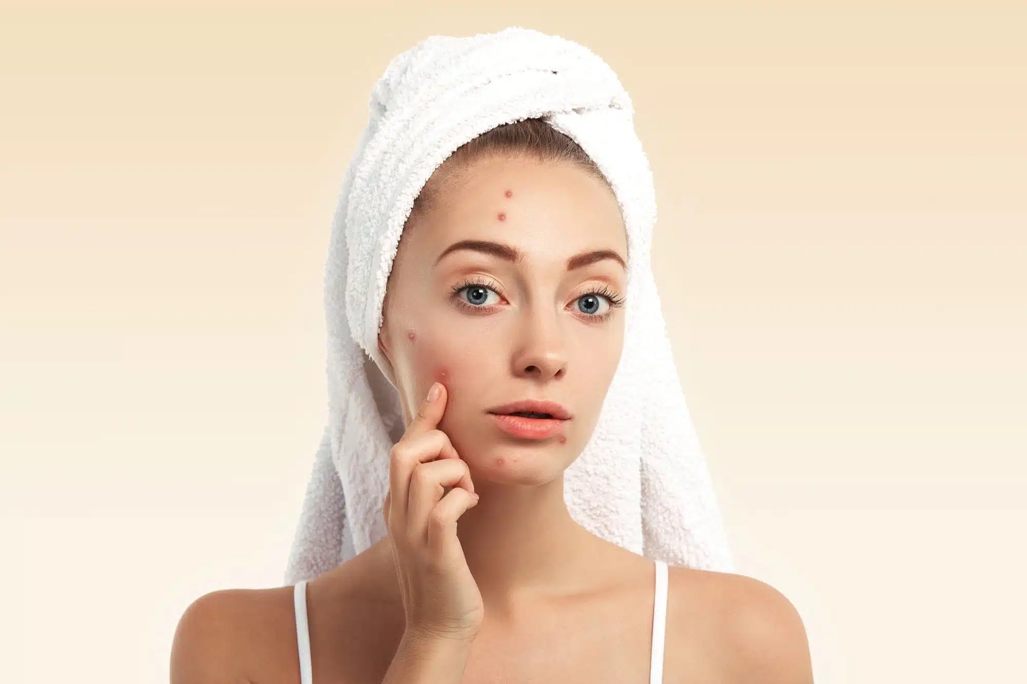 علاج حب الشباب طبيعياً بسرعة بالمنزل 3 علاج حب الشباب طبيعياً بسرعة بالمنزل
